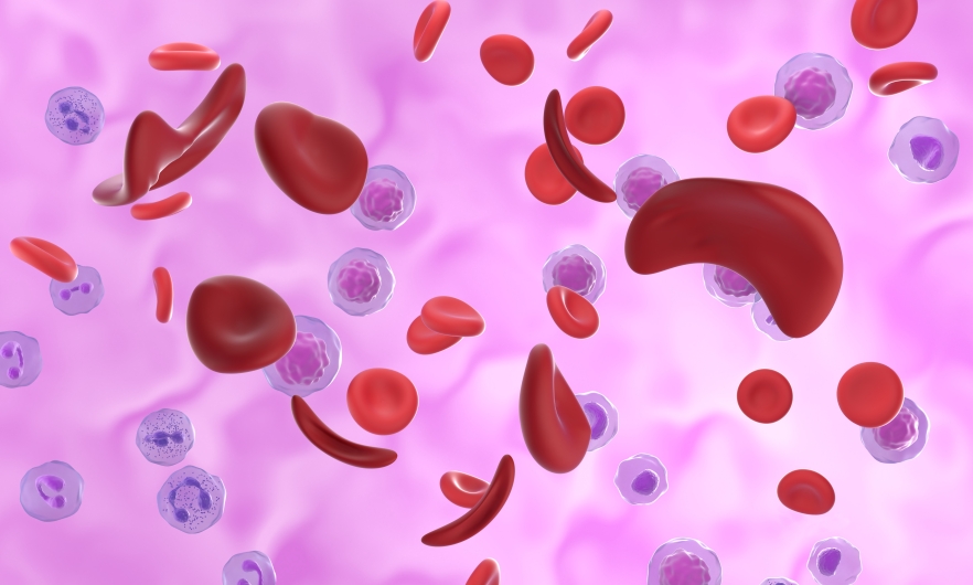 Illustration of red blood cells affected by sickle cell disease.