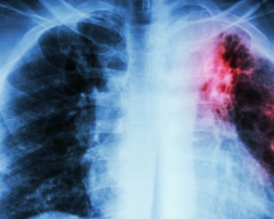 Chest X-ray : interstitial infiltration at left upper lung due to Mycobacterium Tuberculosis infection