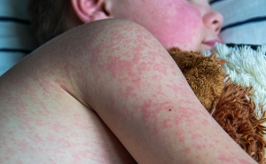 A young child with measles rash all over their body lies in bed and hugs a teddy bear.