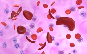 Illustration of red blood cells affected by sickle cell disease.